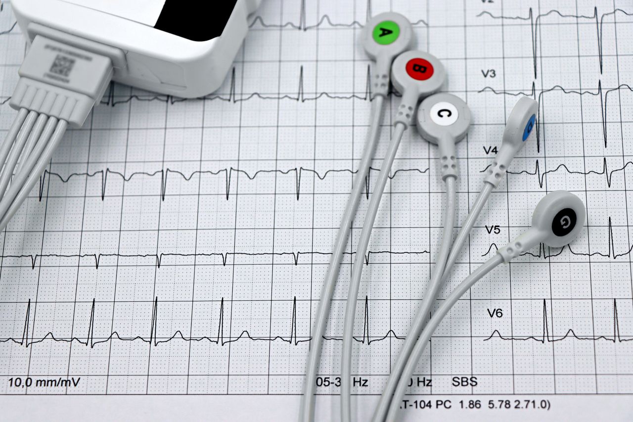 project-01-a Close-up of ECG monitor leads on a printed cardiogram, showcasing heart health diagnostics.